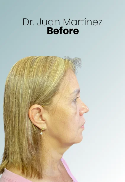 Neck Lift Procedure Img5 Queen Catalina