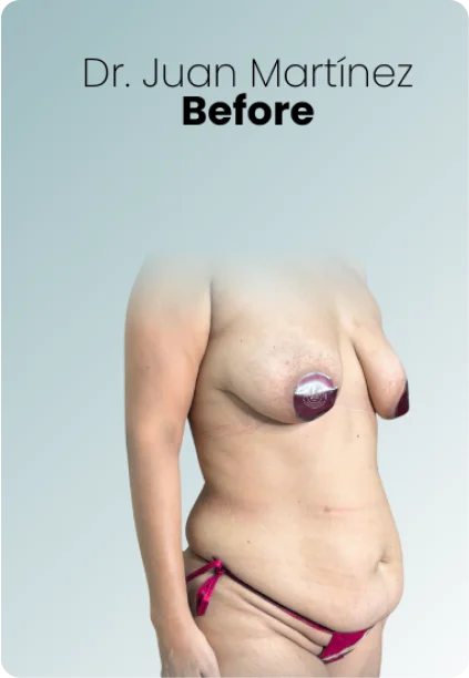 Post Bariatric Surgery Procedure Img1 Queen Catalina