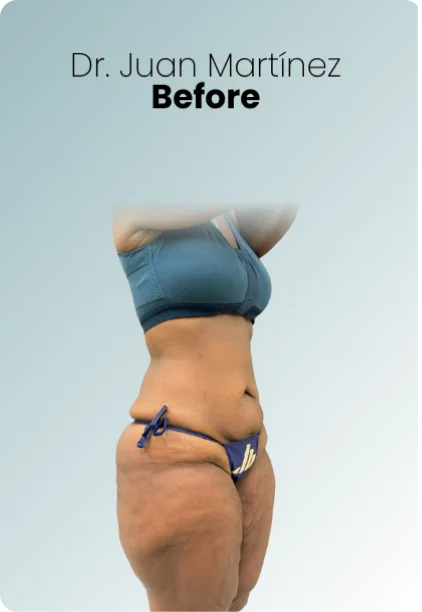 Post Bariatric Surgery Procedure Img3 Queen Catalina