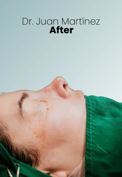 Rhinoplasty Procedure Img1 Queen Catalina