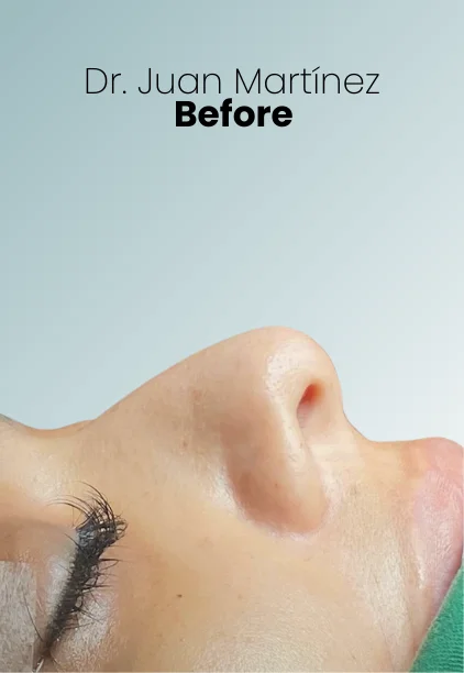 Rhinoplasty Procedure Img12 Queen Catalina