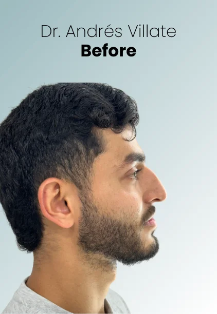 Rhinoplasty Procedure Img2 Queen Catalina