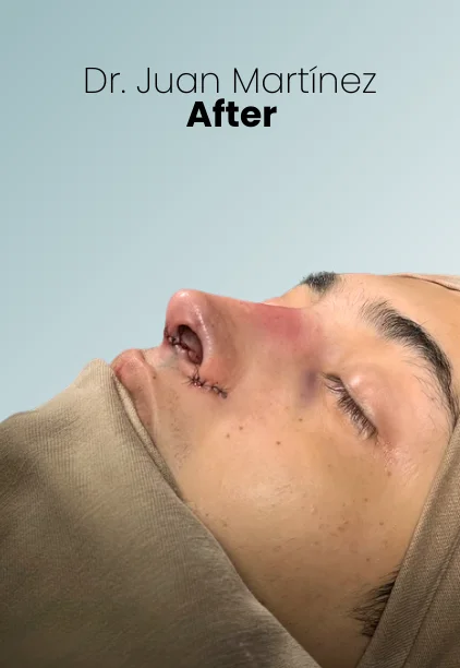 Rhinoplasty Procedure Img4 Queen Catalina