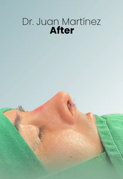 Rhinoplasty Procedure Img6 Queen Catalina