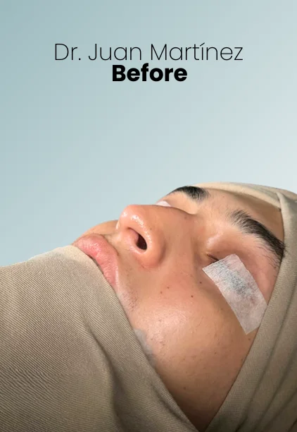 Rhinoplasty Procedure Img7 Queen Catalina