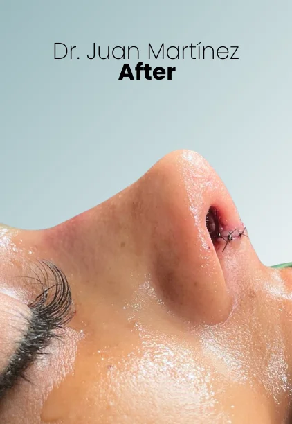 Rhinoplasty Procedure Img8 Queen Catalina