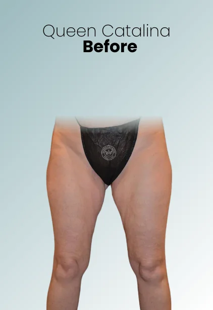 Thigh Lift Procedure Img1 Queen Catalina