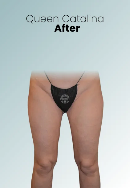 Thigh Lift Procedure Img2 Queen Catalina
