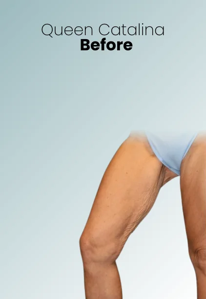 Thigh Lift Procedure Img3 Queen Catalina