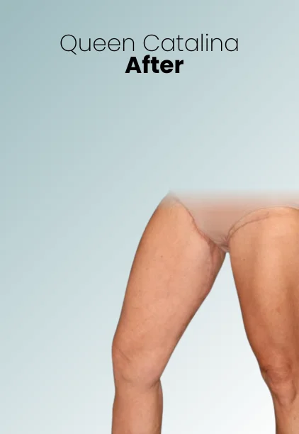 Thigh Lift Procedure Img4 Queen Catalina