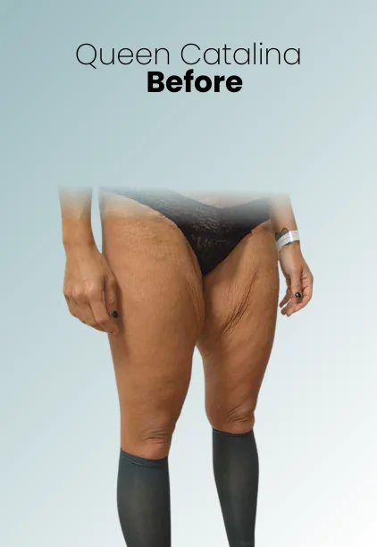 Thigh Lift Procedure Img5 Queen Catalina