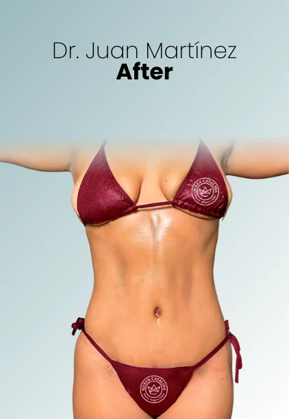 Tummy Tuck Procedure Img10 Queen Catalina
