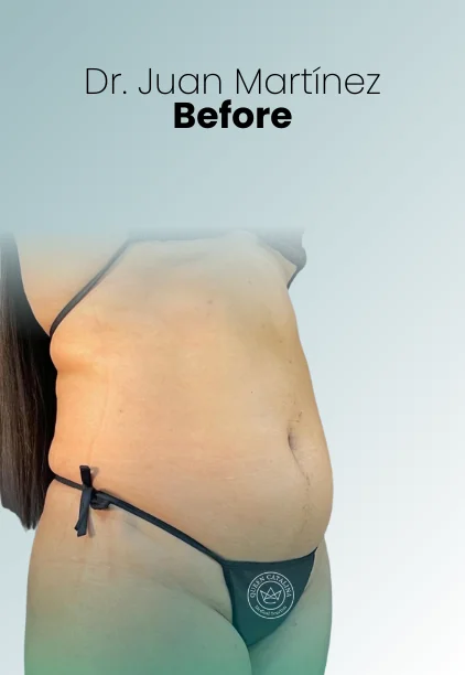 Tummy Tuck Procedure Img13 Queen Catalina