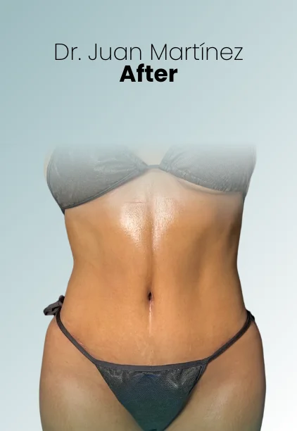 Tummy Tuck Procedure Img14 Queen Catalina