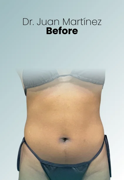 Tummy Tuck Procedure Img2 Queen Catalina