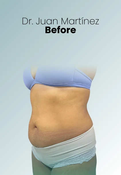 Tummy Tuck Procedure Img5 Queen Catalina