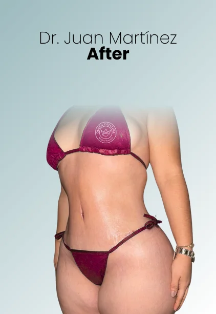 Tummy Tuck Procedure Img7 Queen Catalina