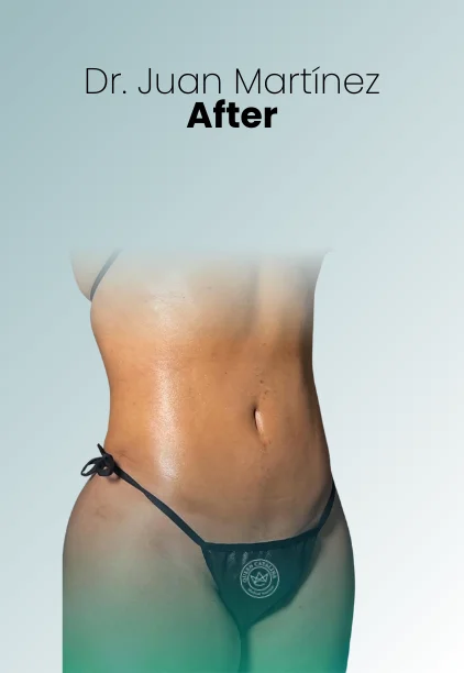 Tummy Tuck Procedure Img8 Queen Catalina