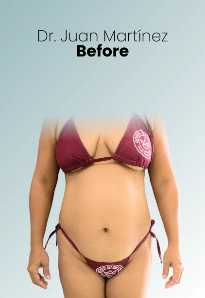 Tummy Tuck Procedure Img9 Queen Catalina