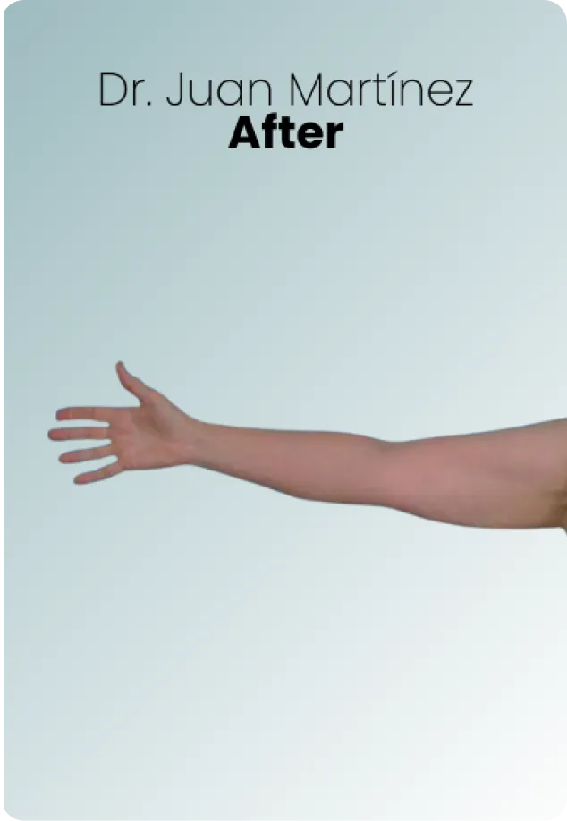 Arm Lift Procedure Img1 Queen Catalina