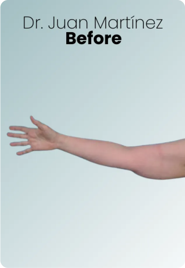 Arm Lift Procedure Img2 Queen Catalina