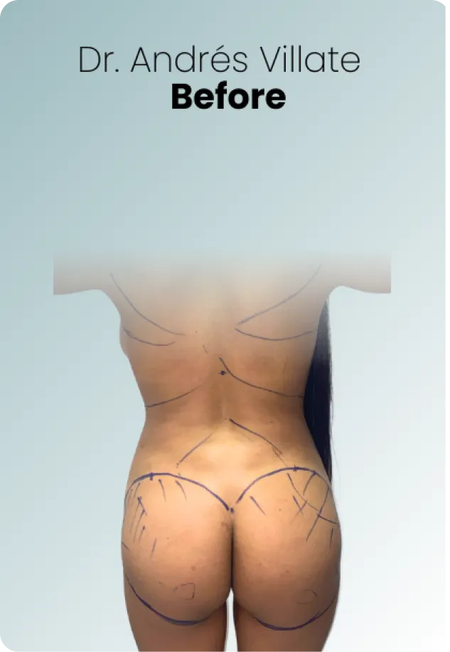 Bbl Procedure Img1 Queen Catalina