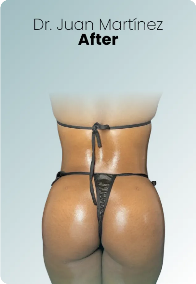 Bbl Procedure Img3 Queen Catalina