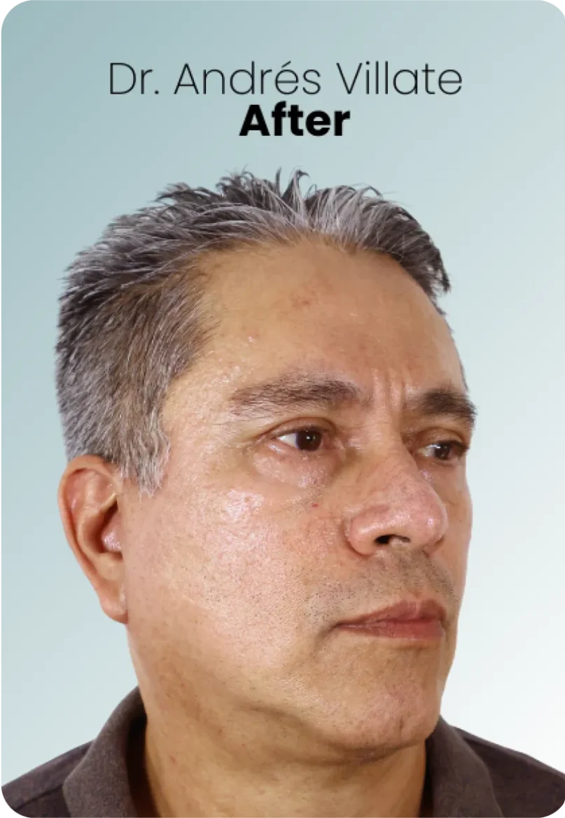 Blepharoplasty Procedure Img1 Queen Catalina