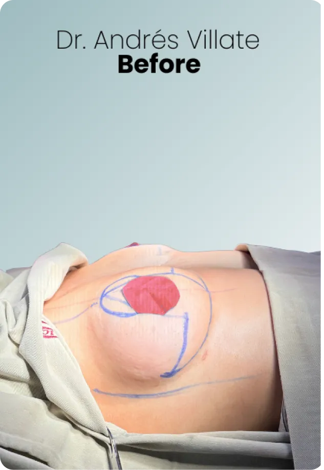 Breast Augmentation Procedure Surgeon Queen Catalina Img1