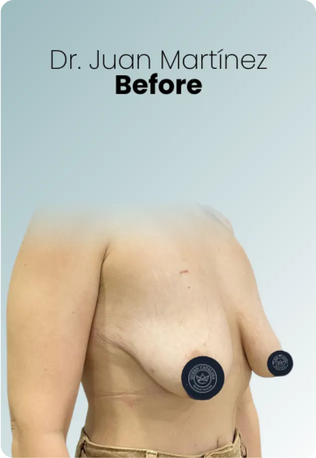 Breast Augmentation Procedure Surgeon Queen Catalina Img10