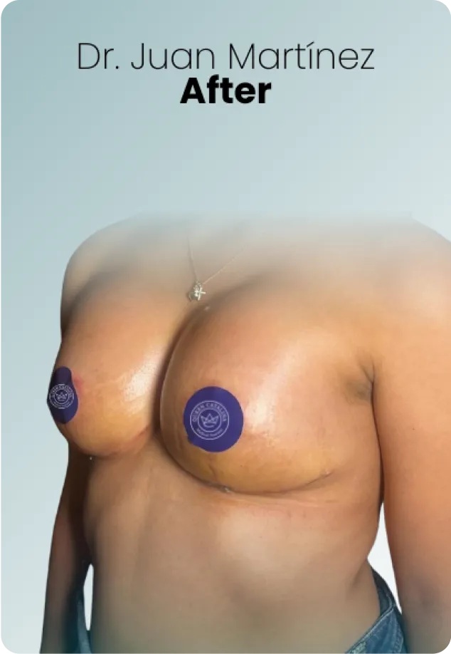 Breast Augmentation Procedure Surgeon Queen Catalina Img11