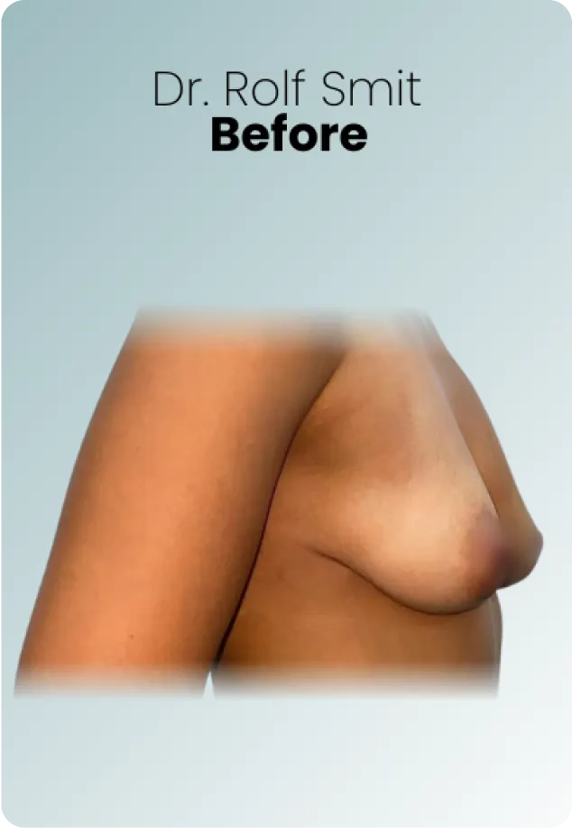 Breast Augmentation Procedure Surgeon Queen Catalina Img12breast Augmentation Procedure Surgeon Queen Catalina Img12