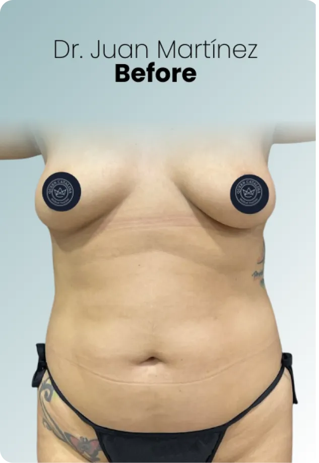 Breast Augmentation Procedure Surgeon Queen Catalina Img13