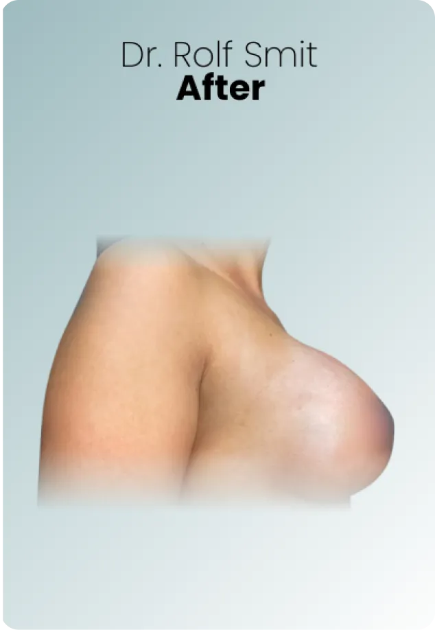 Breast Augmentation Procedure Surgeon Queen Catalina Img14