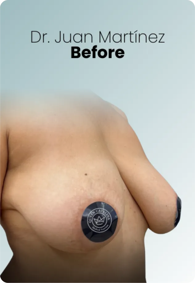 Breast Augmentation Procedure Surgeon Queen Catalina Img16