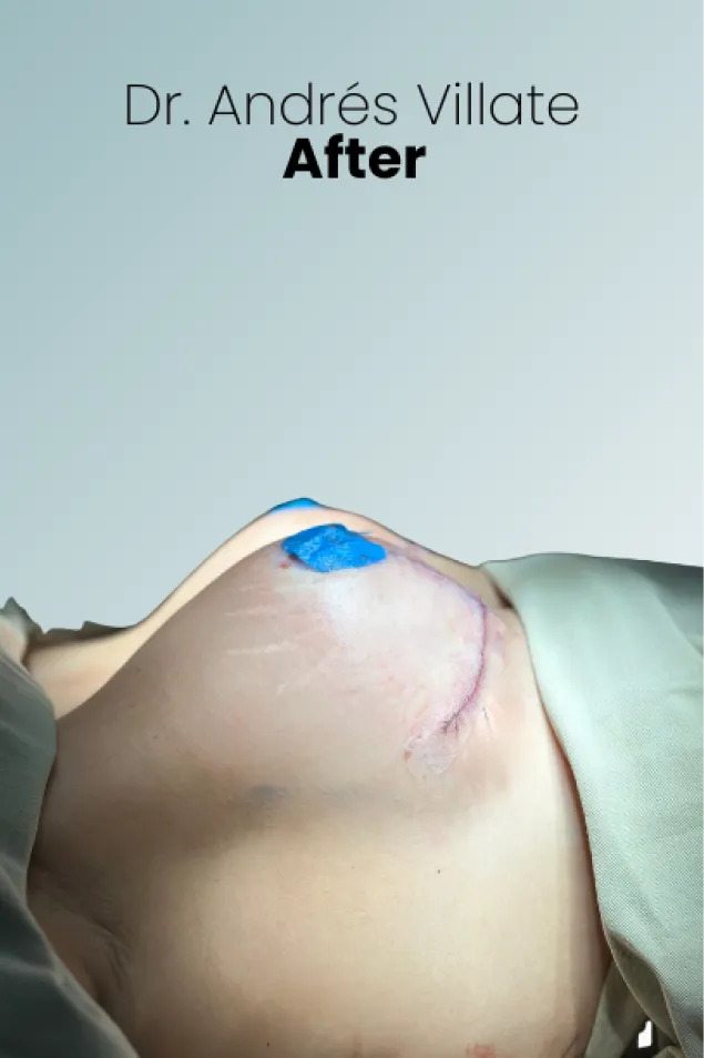 Breast Augmentation Procedure Surgeon Queen Catalina Img2