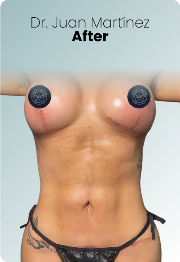 Breast Augmentation Procedure Surgeon Queen Catalina Img3