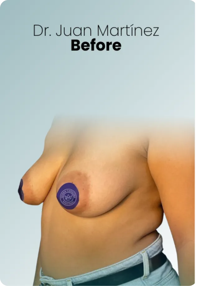 Breast Augmentation Procedure Surgeon Queen Catalina Img4