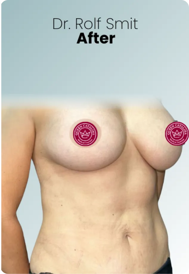 Breast Augmentation Procedure Surgeon Queen Catalina Img7