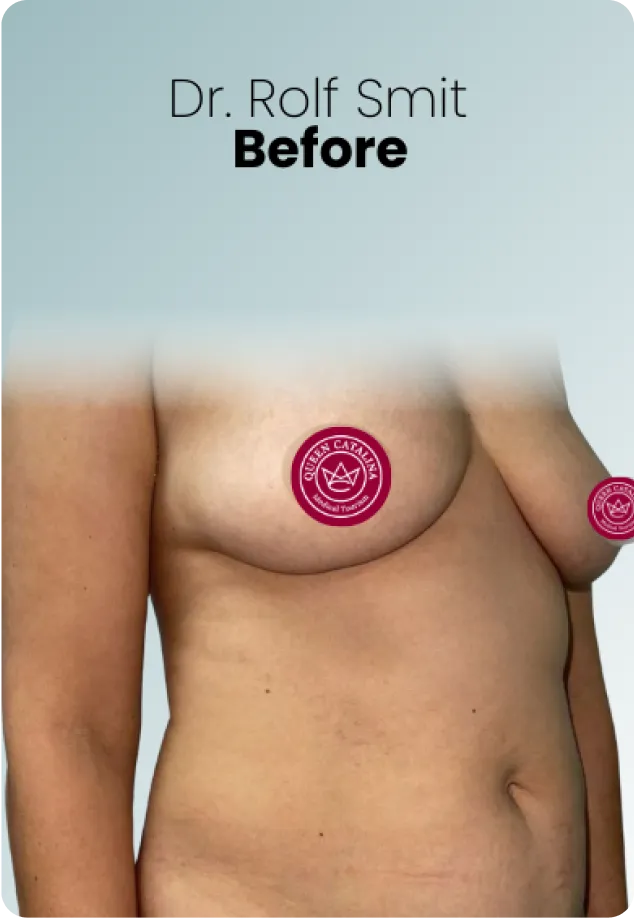 Breast Augmentation Procedure Surgeon Queen Catalina Img8