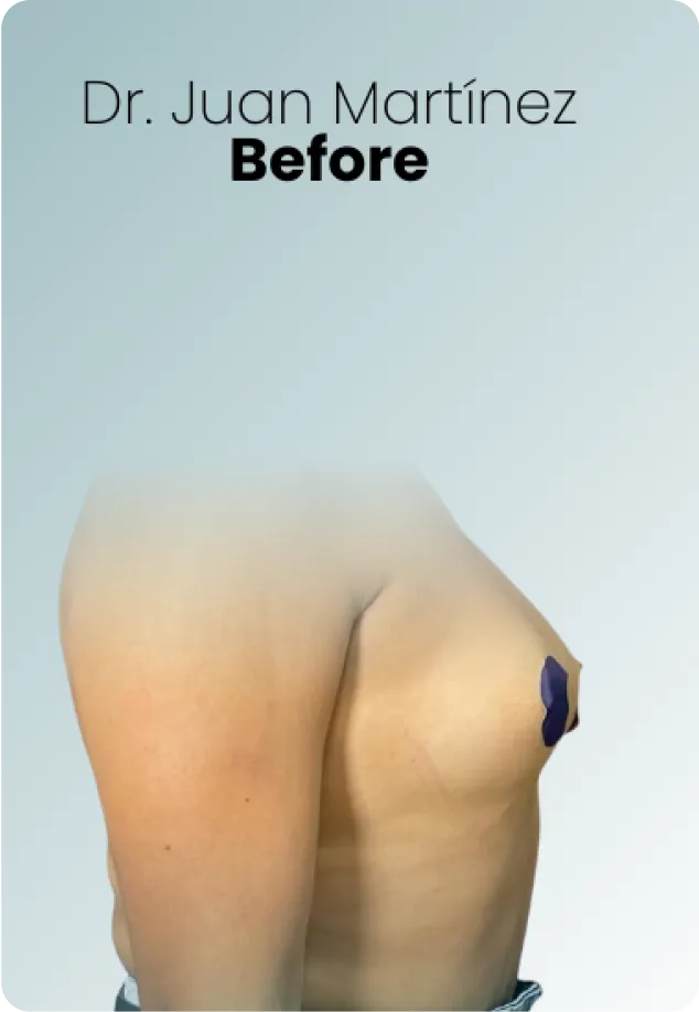 Breast Lift Augmentation Procedure Surgeon Queen Catalina Img10