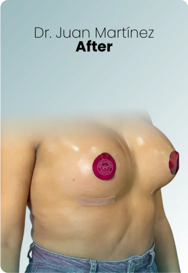 Breast Lift Augmentation Procedure Surgeon Queen Catalina Img11