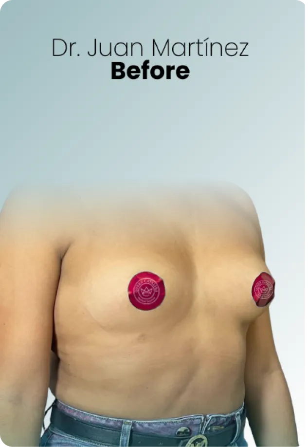 Breast Lift Augmentation Procedure Surgeon Queen Catalina Img12