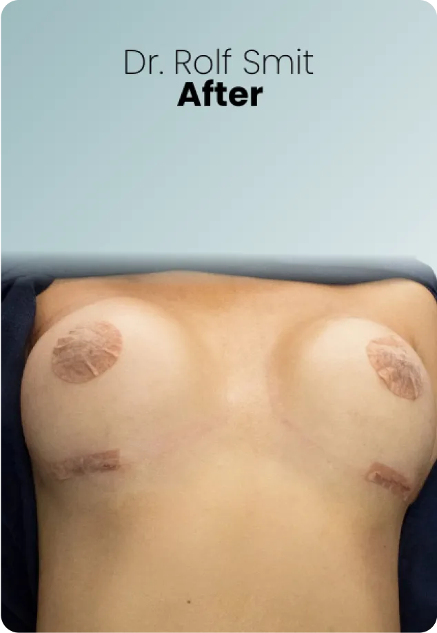 Breast Lift Augmentation Procedure Surgeon Queen Catalina Img14