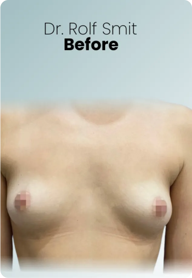 Breast Lift Augmentation Procedure Surgeon Queen Catalina Img15