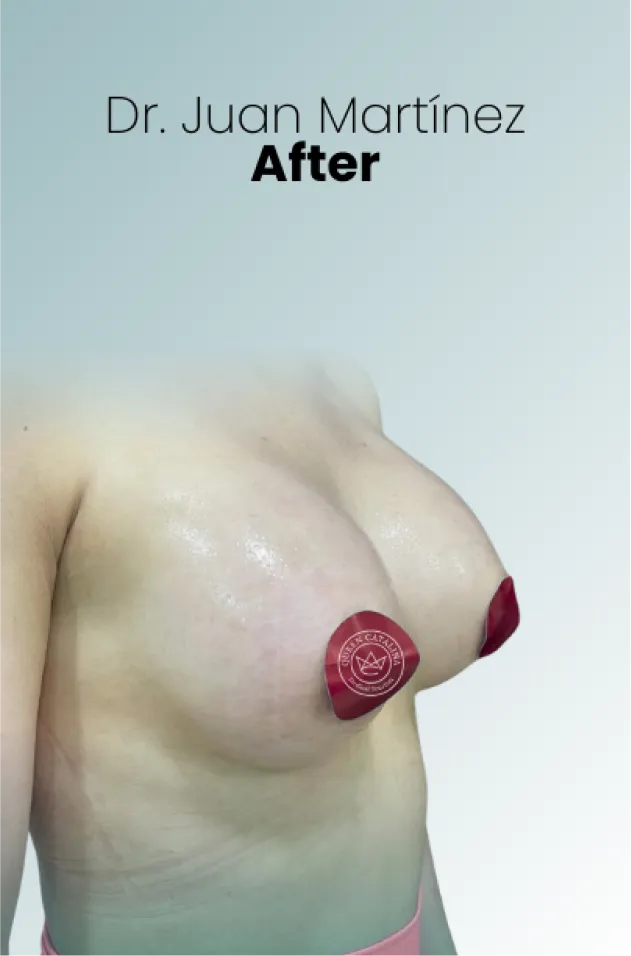 Breast Lift Augmentation Procedure Surgeon Queen Catalina Img16