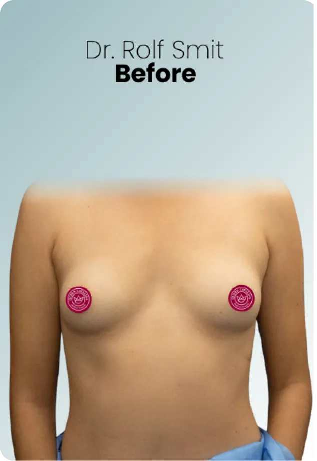 Breast Lift Augmentation Procedure Surgeon Queen Catalina Img17