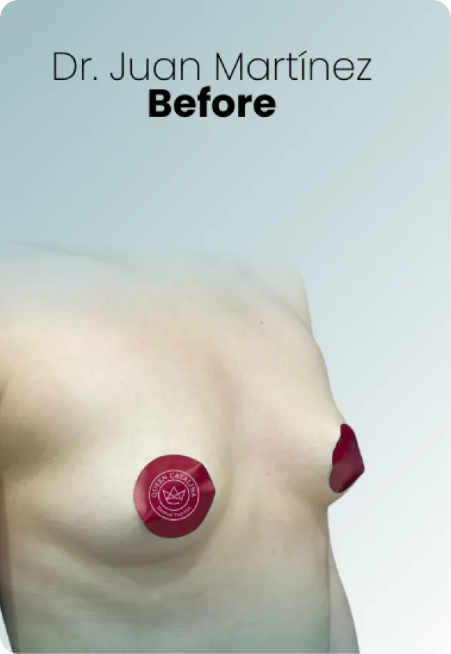 Breast Lift Augmentation Procedure Surgeon Queen Catalina Img18