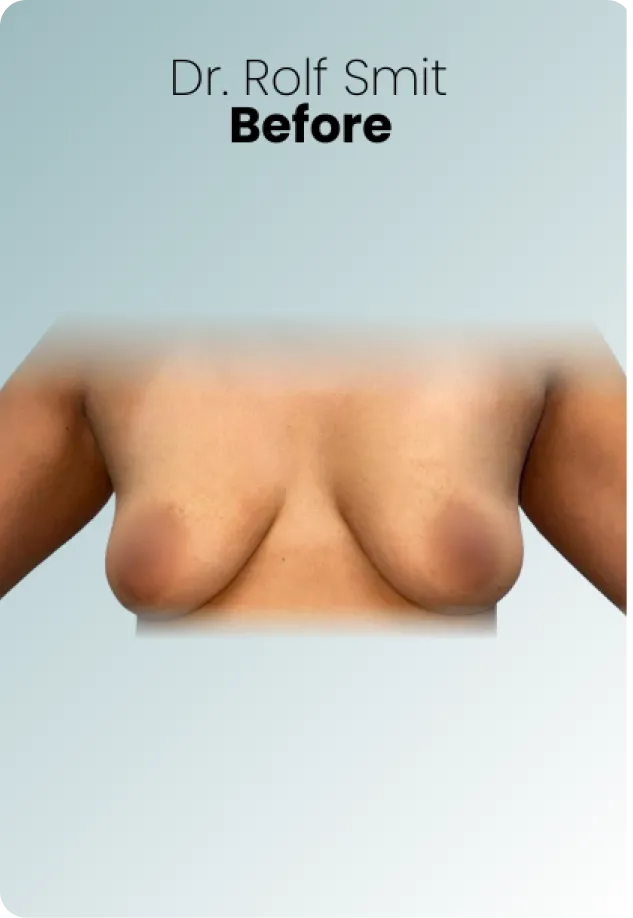Breast Lift Augmentation Procedure Surgeon Queen Catalina Img2