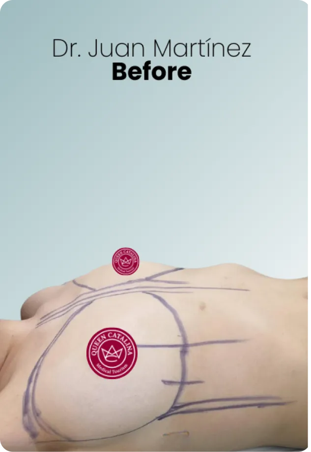 Breast Lift Augmentation Procedure Surgeon Queen Catalina Img20